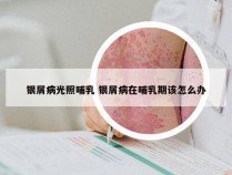 银屑病光照哺乳 银屑病在哺乳期该怎么办