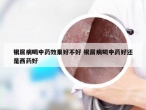 银屑病喝中药效果好不好 银屑病喝中药好还是西药好