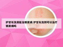 炉甘石洗液能治银屑病 炉甘石洗剂可以治疗银屑病吗