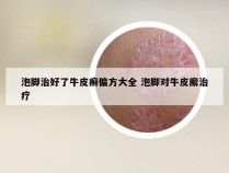 泡脚治好了牛皮癣偏方大全 泡脚对牛皮廨治疗