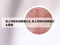 身上对称长的癣是什么 身上对称长的癣是什么原因