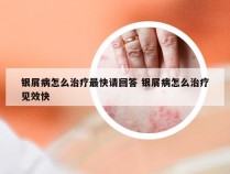 银屑病怎么治疗最快请回答 银屑病怎么治疗见效快