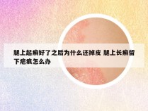 腿上起癣好了之后为什么还掉皮 腿上长癣留下疤痕怎么办