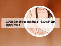 先天性白斑是什么原因造成的 先天性的白斑需要治疗吗?