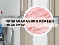 如何提高自身免疫力治银屑病 银屑病患者如何提高自身免疫力