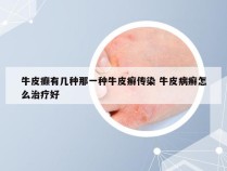 牛皮癫有几种那一种牛皮癣传染 牛皮病癣怎么治疗好