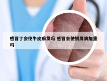 感冒了会使牛皮癣发吗 感冒会使银屑病加重吗