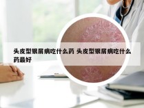 头皮型银屑病吃什么药 头皮型银屑病吃什么药最好