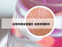 白斑早期证状图片 白斑早期照片