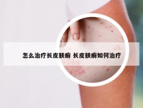 怎么治疗长皮肤癣 长皮肤癣如何治疗