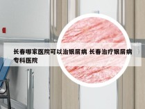 长春哪家医院可以治银屑病 长春治疗银屑病专科医院