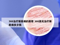 308治疗银屑病的原理 308激光治疗银屑病多少钱