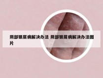 阴部银屑病解决办法 阴部银屑病解决办法图片