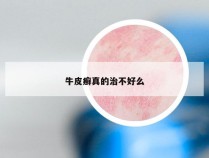 牛皮癣真的治不好么