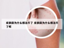 皮肤藓为什么根治不了 皮肤藓为什么根治不了呢