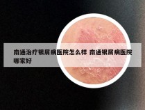 南通治疗银屑病医院怎么样 南通银屑病医院哪家好