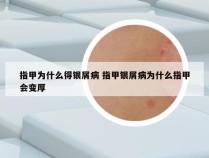 指甲为什么得银屑病 指甲银屑病为什么指甲会变厚