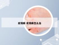 皮钱癣 皮钱癣怎么治