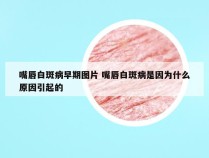 嘴唇白斑病早期图片 嘴唇白斑病是因为什么原因引起的