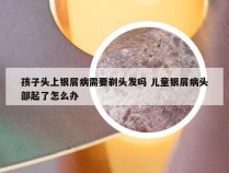 孩子头上银屑病需要剃头发吗 儿童银屑病头部起了怎么办