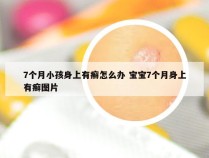 7个月小孩身上有癣怎么办 宝宝7个月身上有癣图片