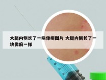 大腿内侧长了一块像癣图片 大腿内侧长了一块像癣一样