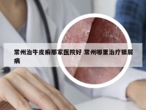 常州治牛皮癣那家医院好 常州哪里治疗银屑病