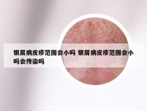 银屑病皮疹范围会小吗 银屑病皮疹范围会小吗会传染吗