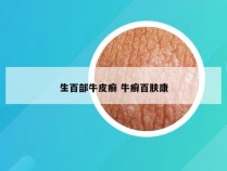 生百部牛皮癣 牛癣百肤康