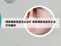 银屑病肾阳虚怎么治疗 银屑病肾阳虚怎么治疗效果好