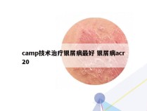 camp技术治疗银屑病最好 银屑病acr20