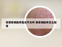 有银屑病腿疼是关节炎吗 银屑病腿疼怎么回事