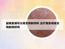 副银屑病可以用生物制剂吗 治疗银屑病用生物制剂好吗