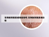 生物制剂银屑病海南有吗 生物制剂银屑病价格