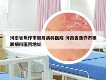 河南省焦作市银屑病科医院 河南省焦作市银屑病科医院地址