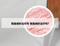 银翘病好治疗吗 银翘病好治疗吗?