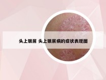 头上银屑 头上银屑病的症状表现图