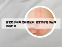 宝宝热疹和牛皮癣的区别 宝宝热疹是摸起来糙糙的吗