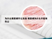 为什么银屑病不让洗澡 银屑病为什么不能有伤口