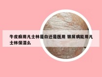 牛皮癣用凡士林是白还是医用 银屑病能用凡士林保湿么