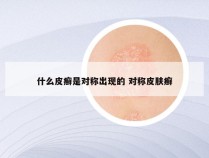 什么皮癣是对称出现的 对称皮肤癣