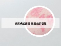 银屑病起困因 银屑病的引起