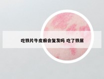 吃铁片牛皮癣会复发吗 吃了铁屑