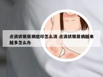 点滴状银屑病痘印怎么消 点滴状银屑病越来越多怎么办