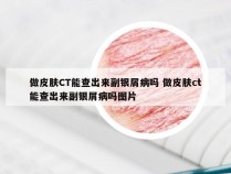 做皮肤CT能查出来副银屑病吗 做皮肤ct能查出来副银屑病吗图片