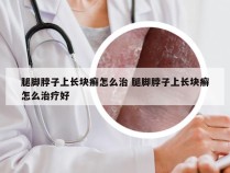 腿脚脖子上长块癣怎么治 腿脚脖子上长块癣怎么治疗好