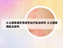 小儿银屑病早发现早治疗能治好吗 小儿银屑病能治愈吗