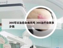 308可以治愈白癜风吗 308治疗白斑多少钱