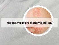 银屑病最严重会怎样 银屑病严重吗好治吗