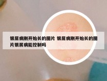 银屑病刚开始长的图片 银屑病刚开始长的图片银屑病能控制吗